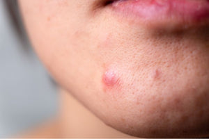 What is acne and how to treat it