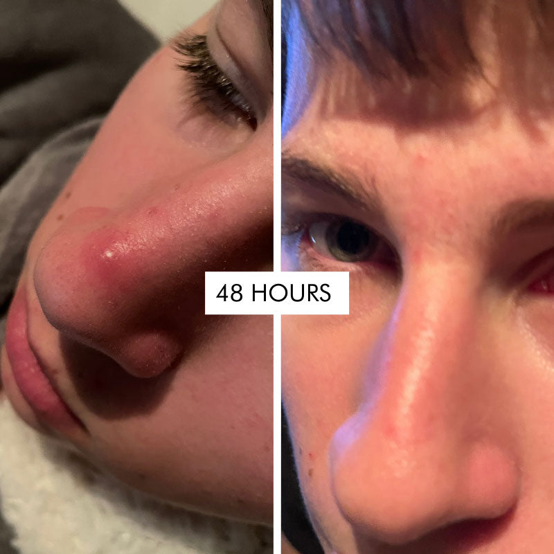 Skin:Genius 'hits the spot' purifying gel