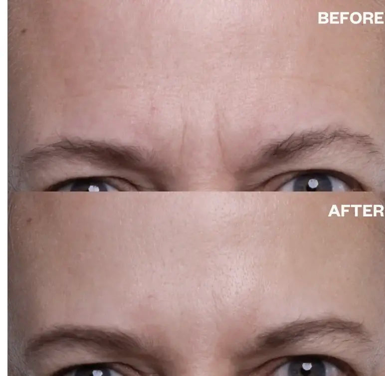 Wrinkles Schminkles Forehead Wrinkle Patches