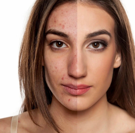 Starest - Acne Control Set